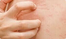 Reazioni allergiche - uno dei sintomi dei parassiti
